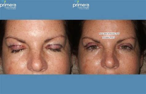 Blepharoplasty Before and After Pictures Case 262 | Orlando & Tampa, Florida | Primera Plastic ...