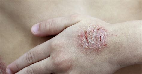 Eczema | Medical, Dietary, Natural [Comprehensive List of Treatments]