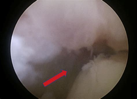 Final result. A secure tenodesis is performed. The surgeon can check... | Download Scientific ...