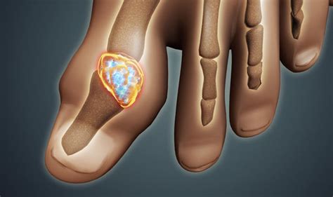 Gout and its types - Overall Science