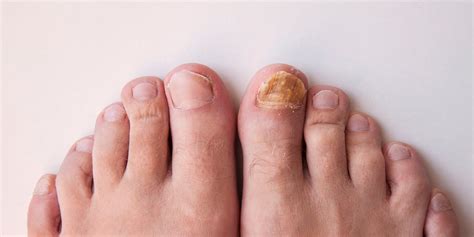 Fungus Problems | Benenati Foot and Ankle Care Centers