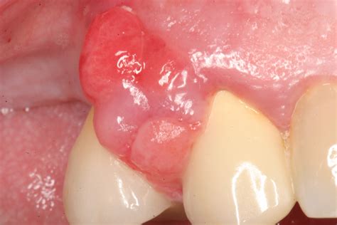 Figure 1 From Management Of Acute Periodontal Abscess - vrogue.co