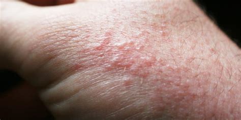 Poison Oak Rash: Symptoms, Treatment, and When to See a Doctor