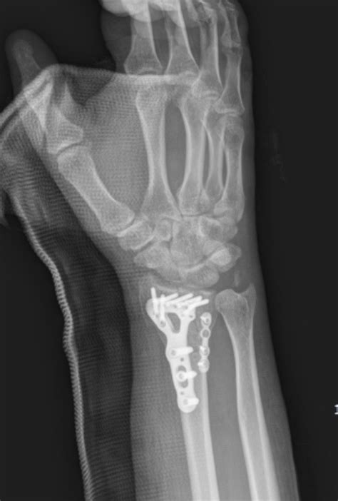 Distal radius fracture surgery - wikidoc