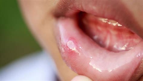 Canker sores: Bioengineer working on bioadhesive patch to treat ulcers ...