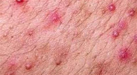 Rash on Groin, Sore, Painful, Red, Groin Rash Causes, Groin Heat Rash, Baby… | Groin rash, Heat ...