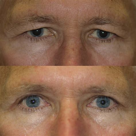 Hyperthyroidism Eyes Before And After