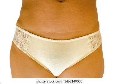 Cosmetic Postoperative Scar Lower Transverse Incision Stock Photo ...