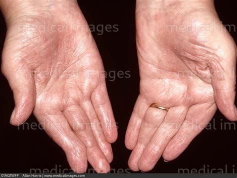 STOCK IMAGE, dermatology mild to moderate palmar psoriasis dry cracked and peeling skin on the ...