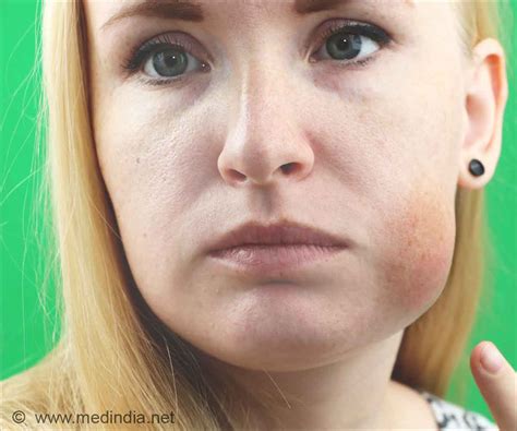 Facial swelling allergy – Telegraph