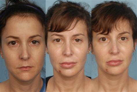 Fat Injections Before & After Photos | Grossman Dermatology