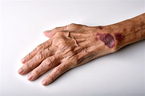 Bruise Wound On Senior People Wrist Arm Skin Falls Injury Accident In ...