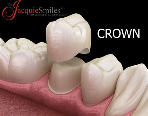 How to Choose a Dentist for Crowns in NYCDr. Jacquie