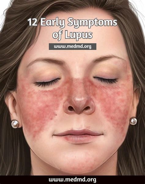 12 Early Symptoms of Lupus | Lupus rash, Lupus symptoms, Lupus diet