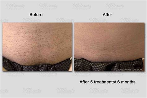 Brazilian Laser Hair Removal Before And After Photos - Hair Style Blog