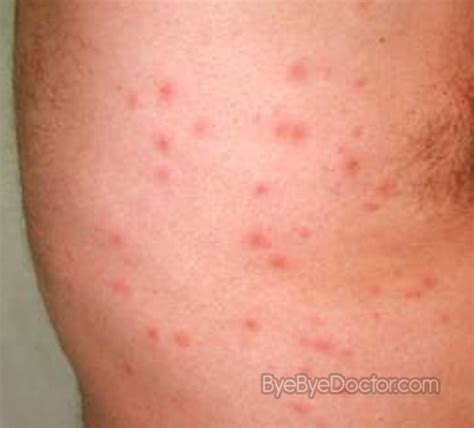 Hot Tub Folliculitis: Prevention and Treatment - HOT TUB 123