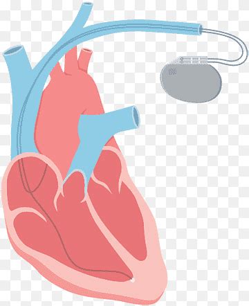 Free download | Heart arrhythmia Tachycardia Catheter ablation, heart beat faster, hand, heart ...