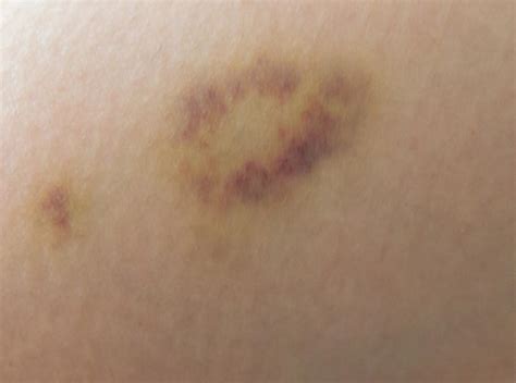 Can Skin Cancer Look Like A Bruise - CancerWalls