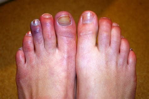 Chilblains On Side Of Foot Cheap Sale | emergencydentistry.com