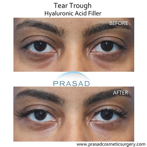 Under Eye Filler Before and After Photos - Prasad Cosmetic Surgery NY