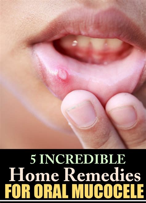 5 Incredible Home Remedies For Oral Mucocele – Natural Home Remedies ...