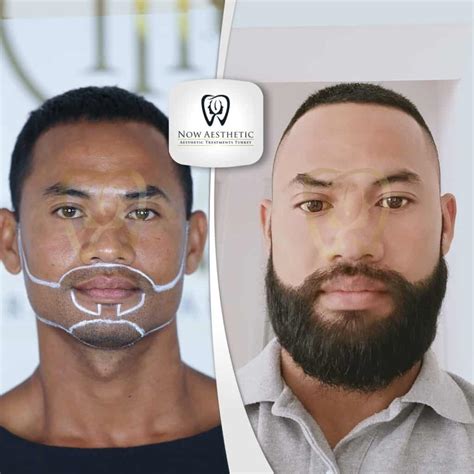 Beard Transplant Before and After 2023 - Now Aesthetic