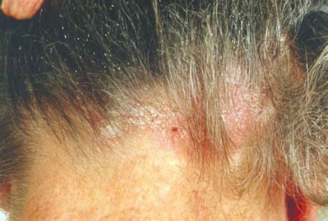 Why Do I Have Red Itchy Spots On My Scalp - Infoupdate.org