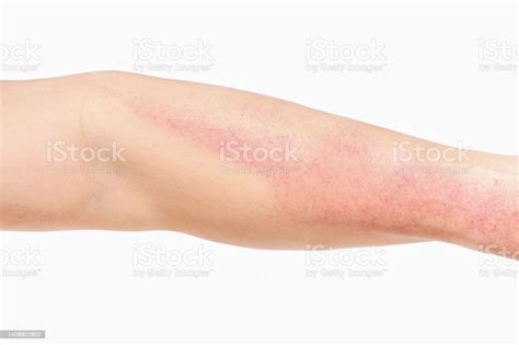 Asian Man Allergy Has Red Rash On Left Arm On White Background Stock Photo - Download Image Now ...