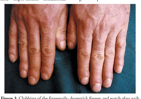 Figure 3 from A Triad of Exophtalmos, Pretibial Myxedema and Acropachy in a Patient With Graves ...