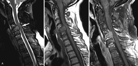 Spinal Stenosis: Cervical | Radiology Key