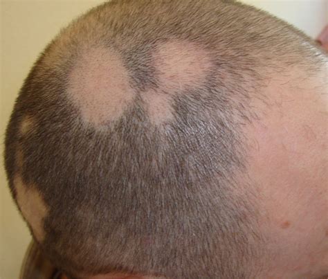 Come curare alopecia areata? Con farmaco anti artrite | zz7 Curiosità, news ed informazioni