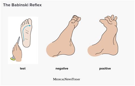 What is the Babinski reflex? | Plantar reflex, Reflexes, Brain test