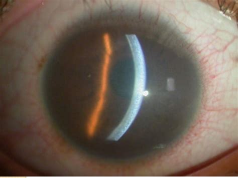 Corneal edema