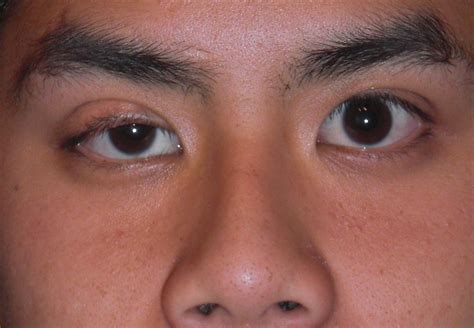 Drooping Eyelids / Eyelid Surgery – Murdoch Ophthalmology Eye Specialist