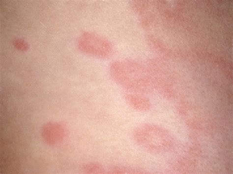 Hives in children | BabyCenter