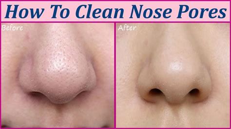 Find out how to Unclog, Clear and Shrink Pores on the Nostril