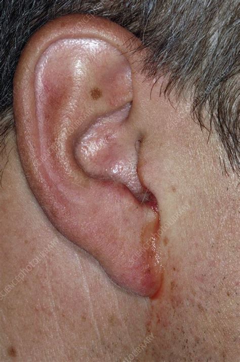 Perforated eardrum with infection - Stock Image - C004/2401 - Science Photo Library