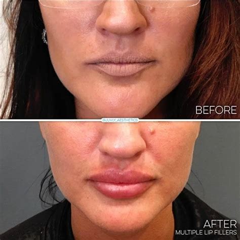 Juvly Aesthetics: Juvederm Ultra Plus For Lip Injections