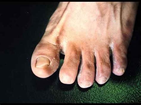 Causes, symptoms of trench foot, treatment of trench foot