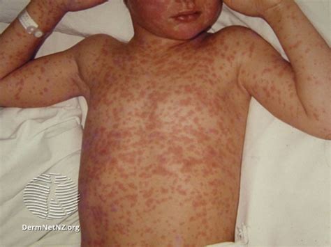 Measles | KidsHealth NZ