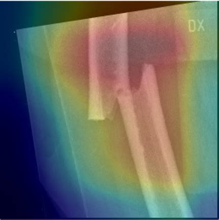 X-ray examinations of atypical femoral fractures | doi:10.23698/aida/affai | AIDA dataset register