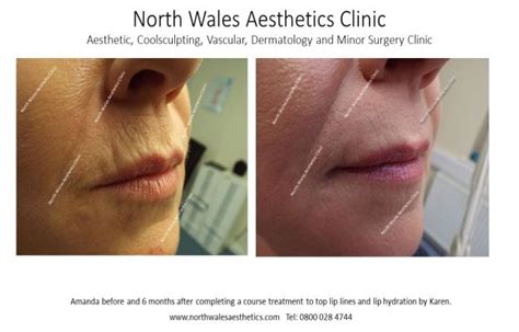 What Causes Vertical Lines On Upper Lip | Sitelip.org