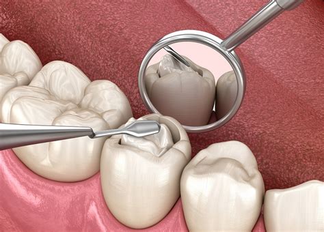 Why You Can Look Forward to Your Tooth Filling | Syosset, NY