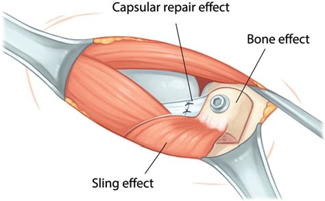 25 Modified Open Latarjet: The “One-Screw” Technique | Musculoskeletal Key