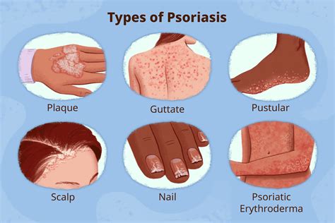 Pustular Psoriasis Face