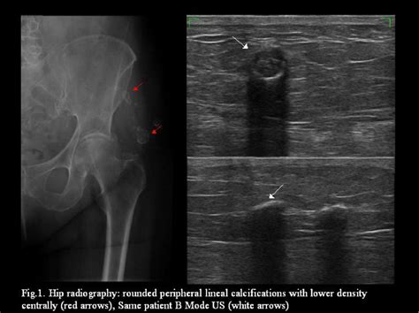 BENIGN LESIONS OF THE SUBCUTANEOUS SOFT TISSUE WITH CALCIFICATIONS. WHICH IS THE ROLE OF ...