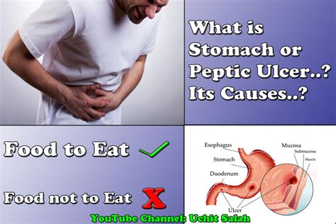 Uchit Salah : Stomach ulcer cure home remedies || Stomach ulcer treatment at home || Peptic ...