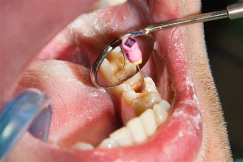 ¿Cuánto dura una endodoncia sin corona? - SOFDental