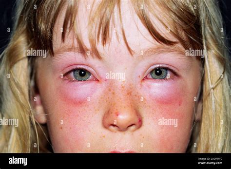 Severe Allergic Reaction Eye Swelling
