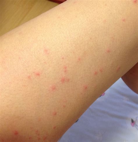 My scabies nightmare experience...do not open if sensitive to pictures with rashes/spots. How to ...